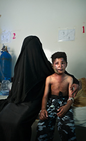 Saada, Yemen- 2017, Oct:  <p class='fr'>Nachmi (9) est arrivé à l'hôpital public de Saada la veille, le 28 octobre 2017 après avoir été la cible d’un bombardement aérien avec son frère Chaher (11) lui aussi gravement blessé à la tête. Ils gardaient leurs bêtes lorsqu'une première bombe les a frappés, puis une deuxième est tombée sur des amis venus leur porter secours. 
</p> <p class='en'>Nachmi (9) and his brother Chaher (11) were hit by an airstrike on the 28th of october 2017 as they were looking after their animals. They are both treated at the public hospital in Saada. </p>
